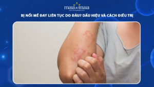 bị nổi mề đay liên tục