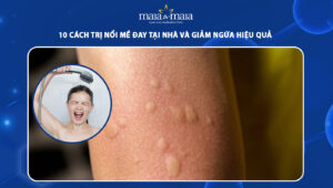 cách trị nổi mề đay tại nhà