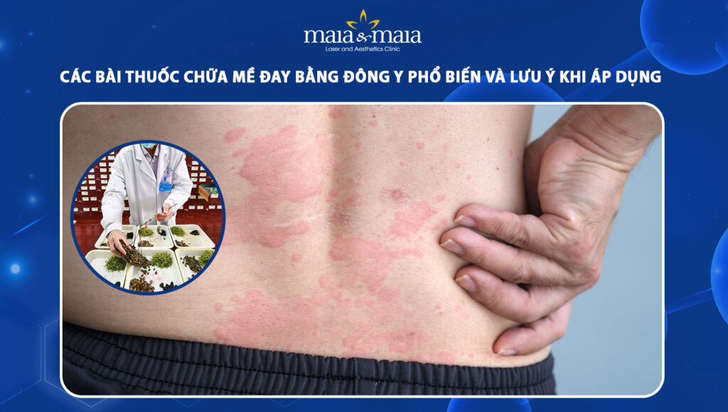 Các bài thuốc chữa mề đay bằng đông y và lưu ý khi áp dụng 1 chữa mề đay bằng đông y