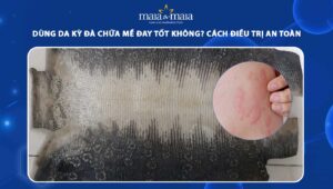da kỳ đà chữa mề đay