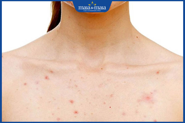 dấu hiệu viêm nang lông ngực