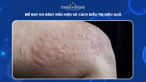 mề đay