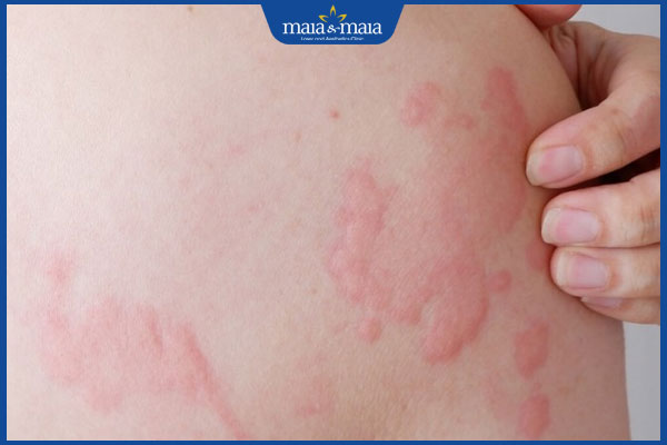 mề đay cấp tính