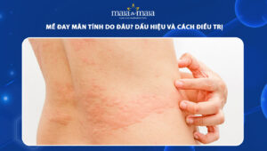 mề đay mãn tính