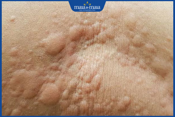 mề đay nặng