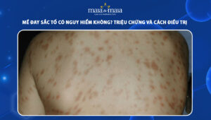mề đay sắc tố