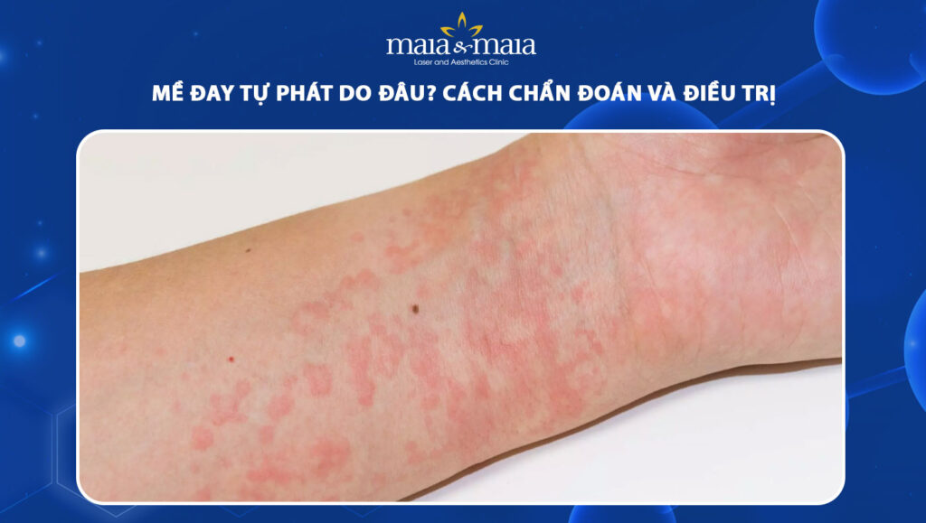 mề đay tự phát