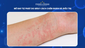 mề đay tự phát