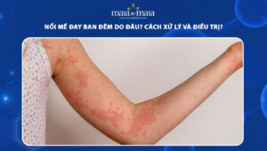 nổi mề đay ban đêm