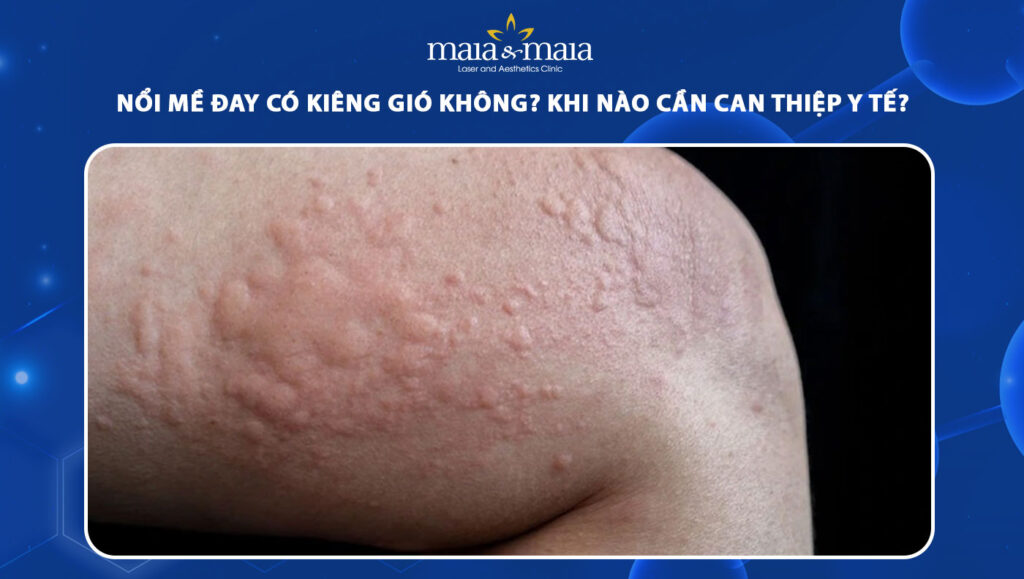 nổi mề đay có kiêng gió không