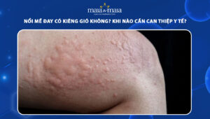 nổi mề đay có kiêng gió không