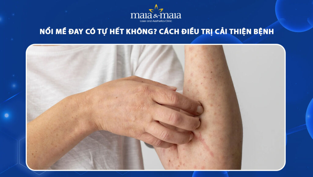 nổi mề đay có tự hết không