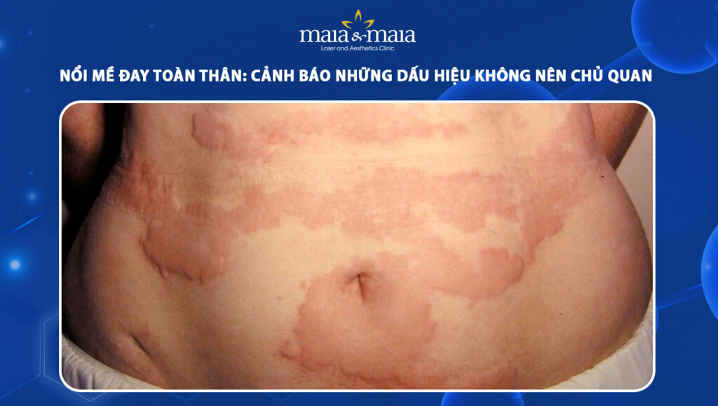 nổi mề đay toàn thân