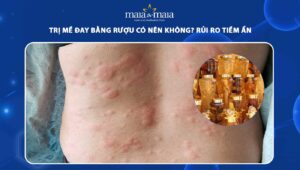 trị mề đay bằng rượu