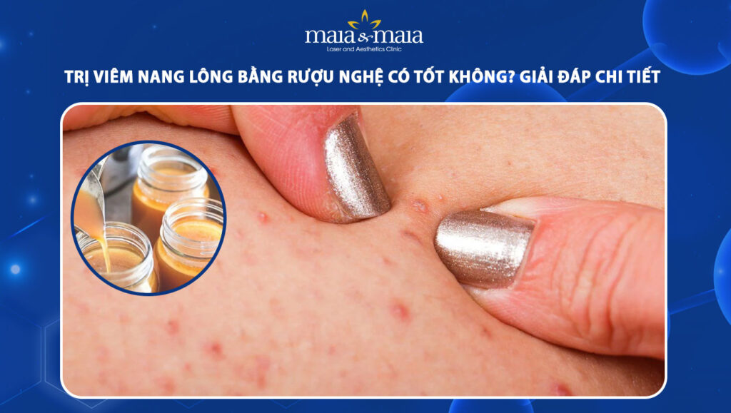 trị viêm nang lông bằng rượu nghệ