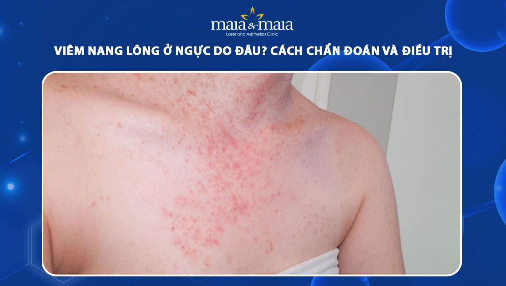 viêm nang lông ở ngực