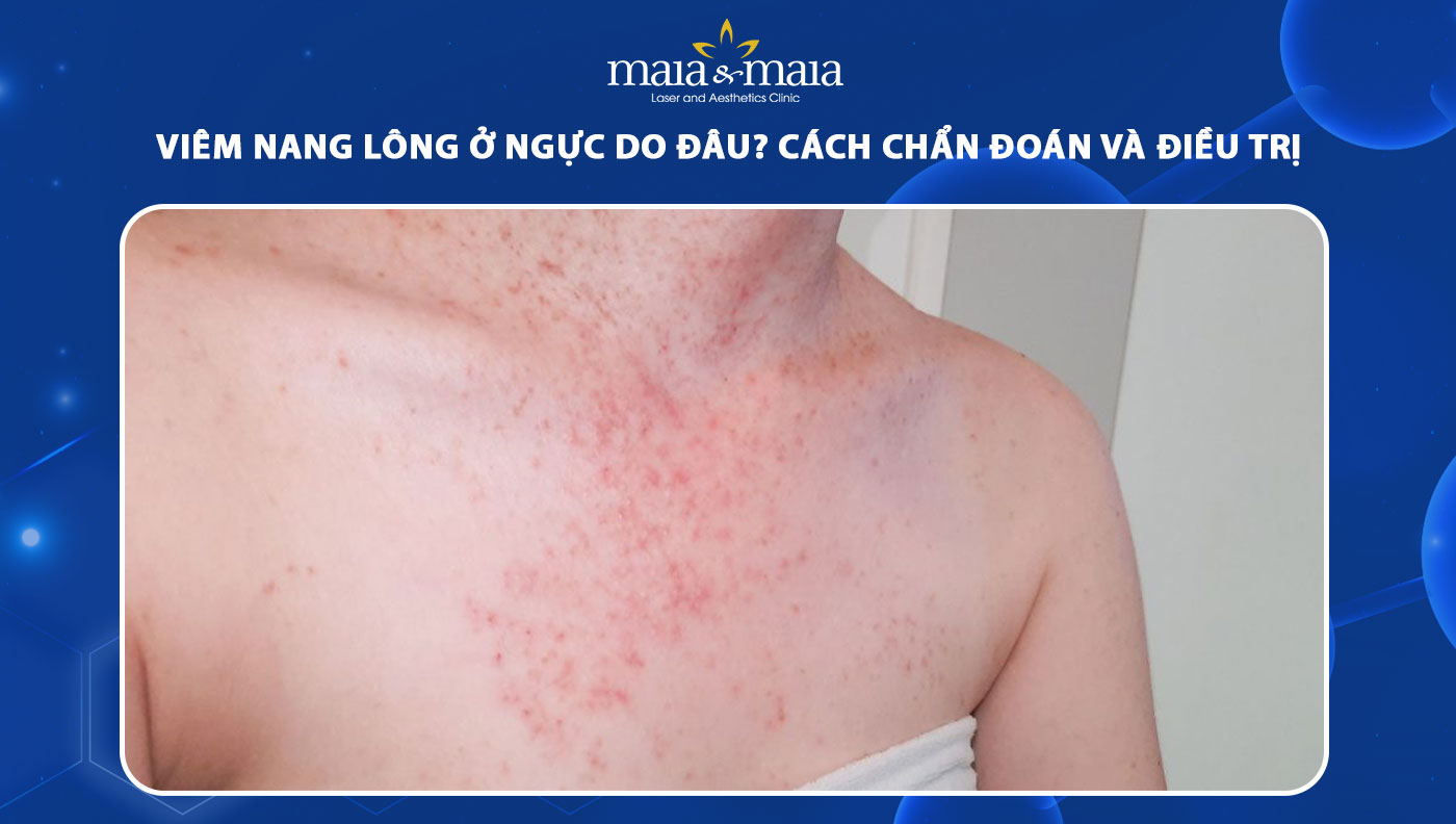 viêm nang lông ở ngực