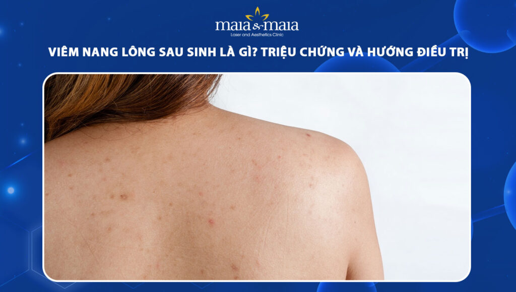 viêm nang lông sau sinh
