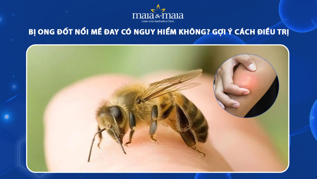 bị ong đốt nổi mề đay