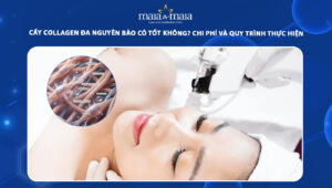 cấy collagen đa nguyên bào