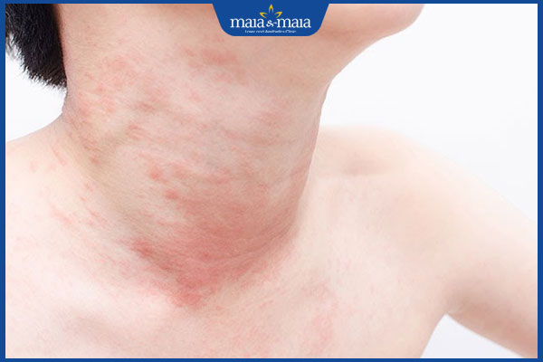 Mề đay ở cổ: Nguyên nhân, dấu hiệu và cách điều trị hiệu quả 2 dấu hiệu mề đay cổ