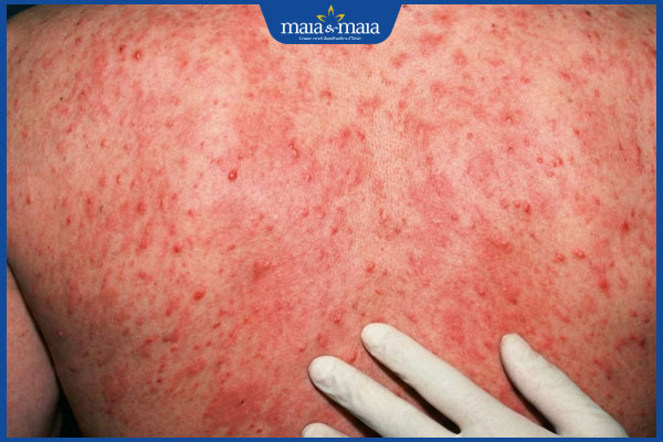 dấu hiệu mề đay do hiv