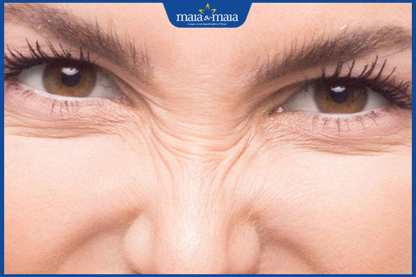 Nếp nhăn sống mũi do đâu? Gợi ý điều trị hiệu quả 2 dấu hiệu nếp nhăn sống mũi