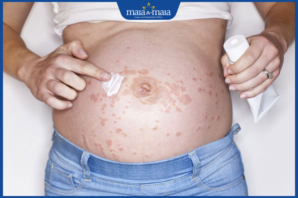 điều trị mề đay khi mang thai