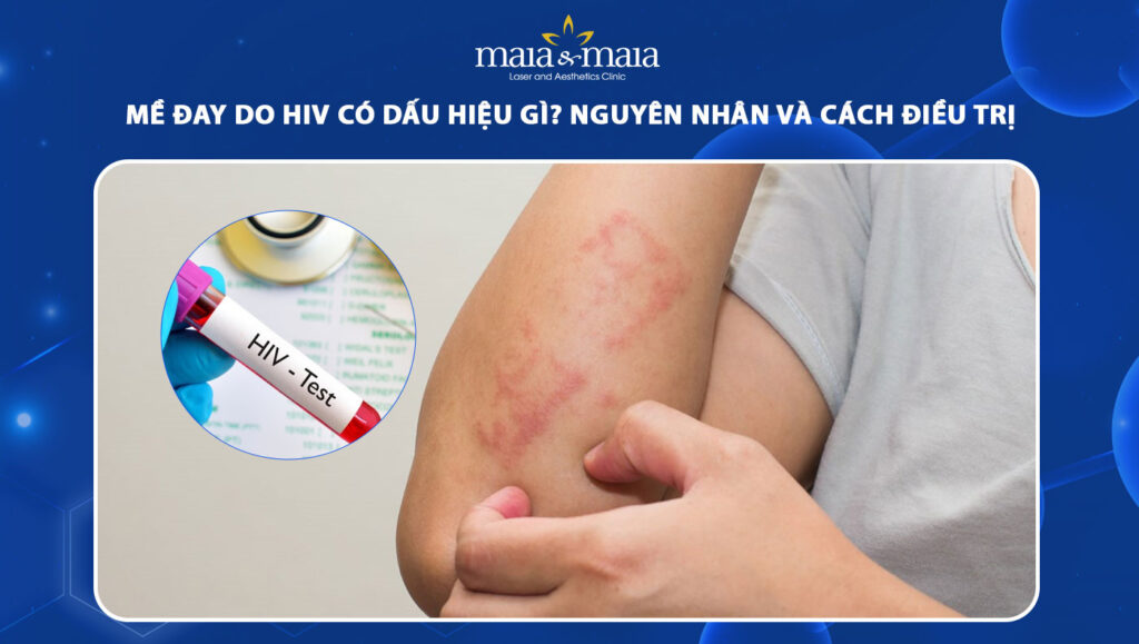 mề đay do hiv