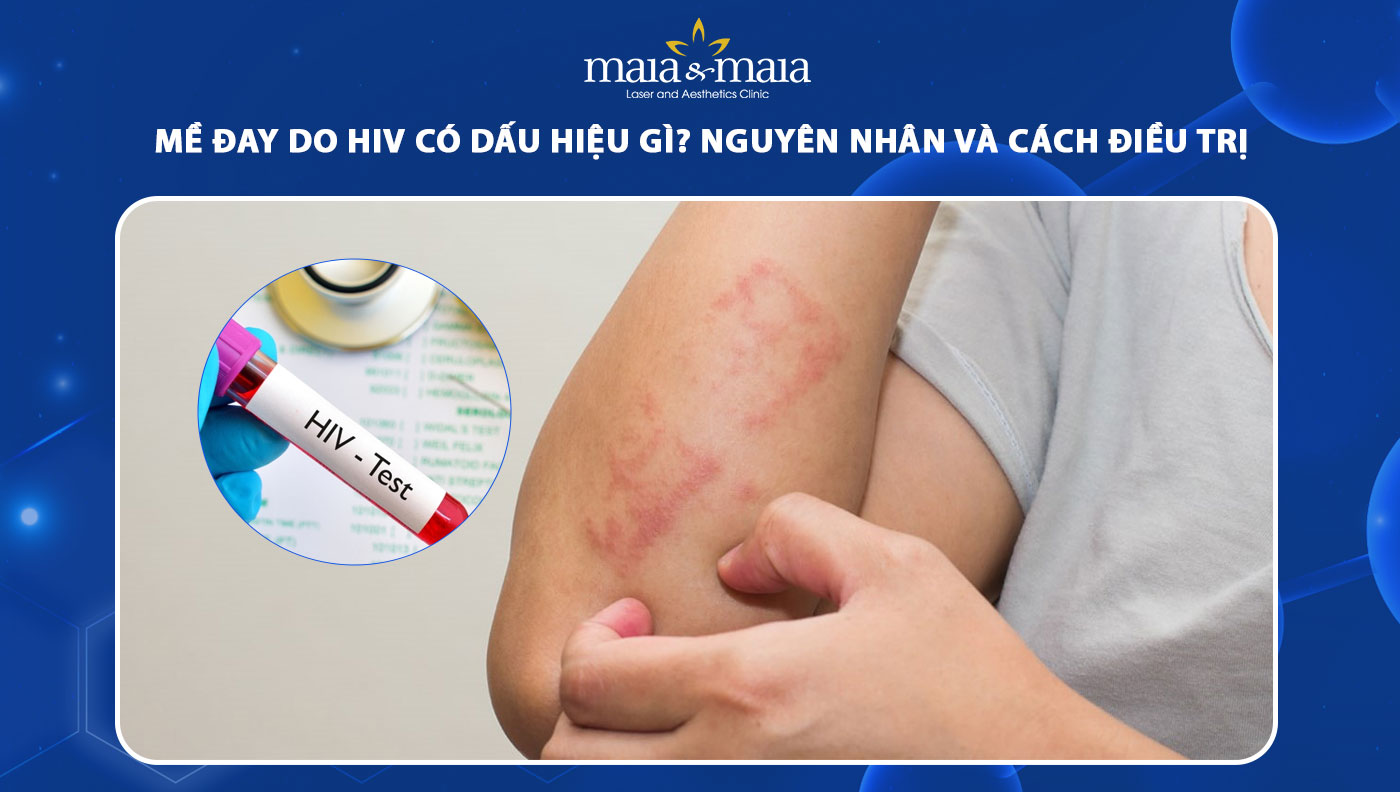 mề đay do hiv