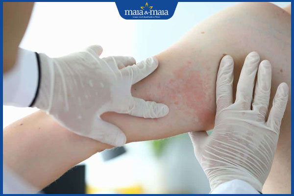 Mẹ bị mề đay sau sinh phải làm sao? Có để con bú được không? 4 mề đay khám bác sĩ