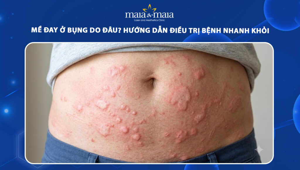 Cách điều trị và kiểm soát mề đay ở bụng bùng phát 1 mề đay ở bụng