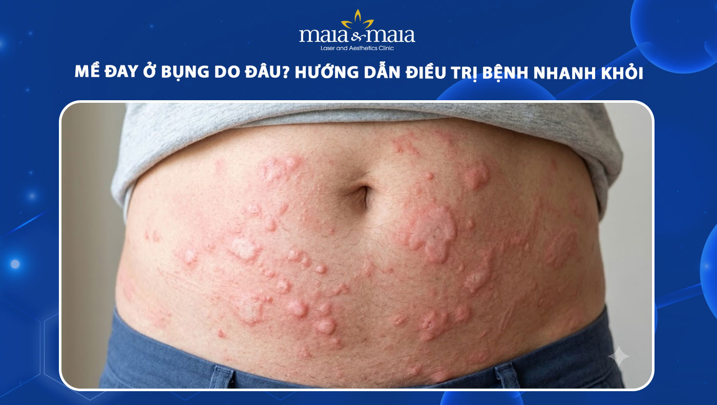 mề đay ở bụng
