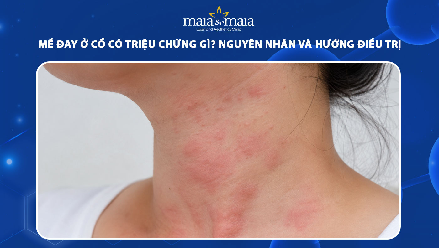 mề đay ở cổ