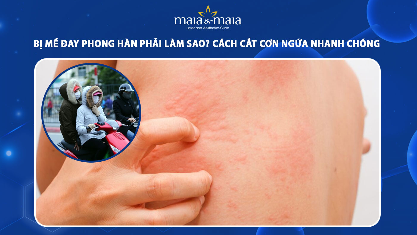 mề đay phong hàn