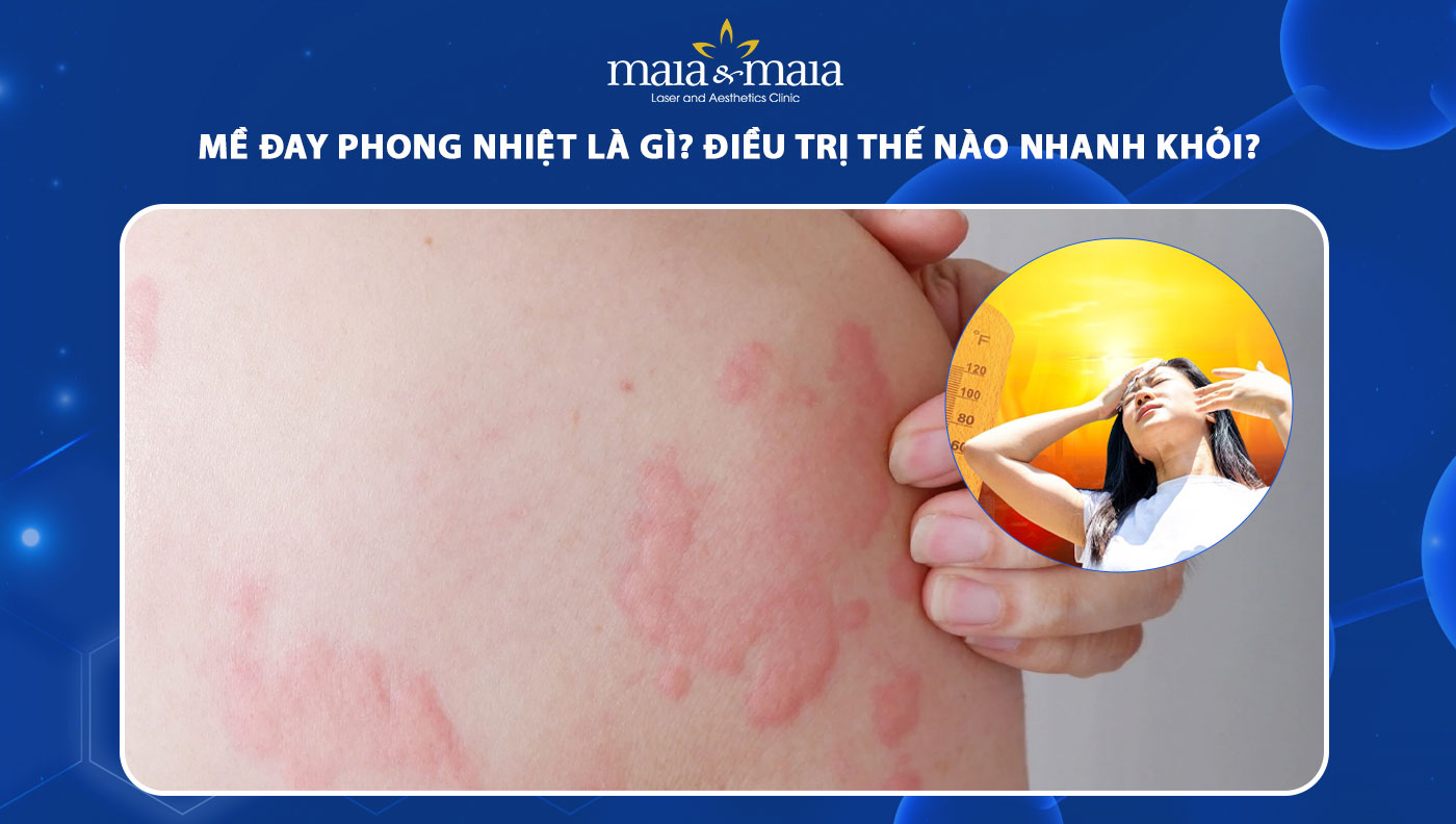 mề đay phong nhiệt