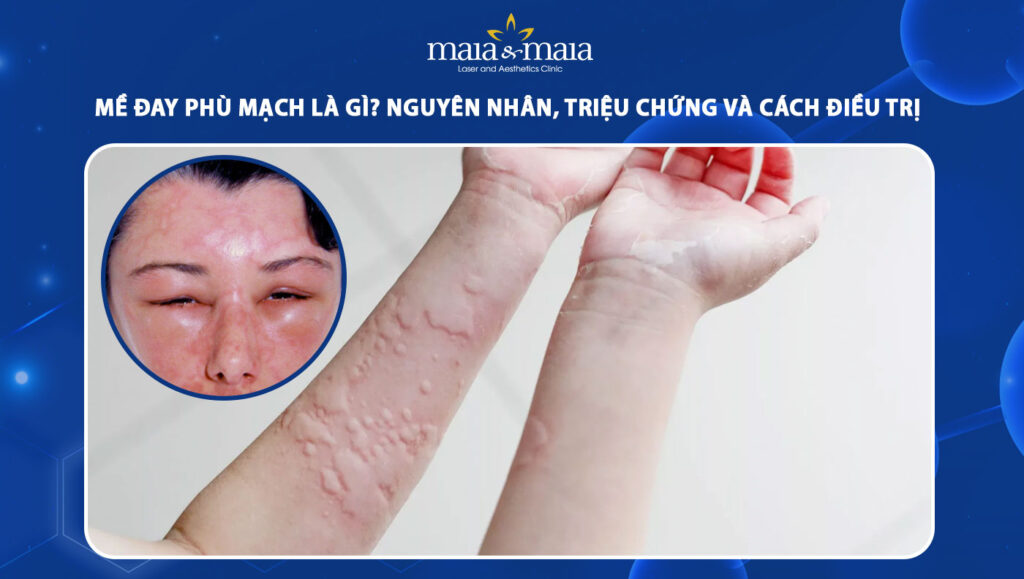 Mề đay phù mạch là gì? Nguyên nhân, dấu hiệu & cách điều trị 1 mề đay phù mạch