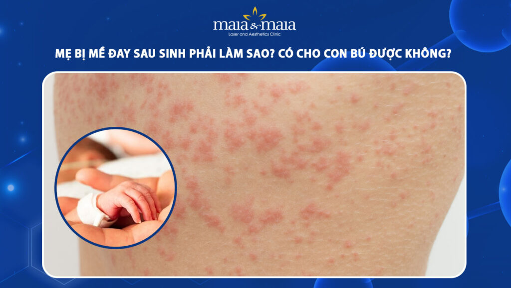 Mẹ bị mề đay sau sinh phải làm sao? Có để con bú được không? 1 mề đay sau sinh