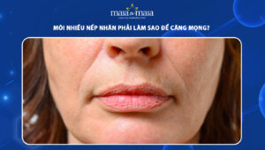 môi nhiều nếp nhăn