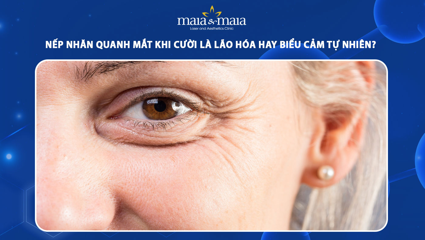 nếp nhăn quanh mắt khi cười
