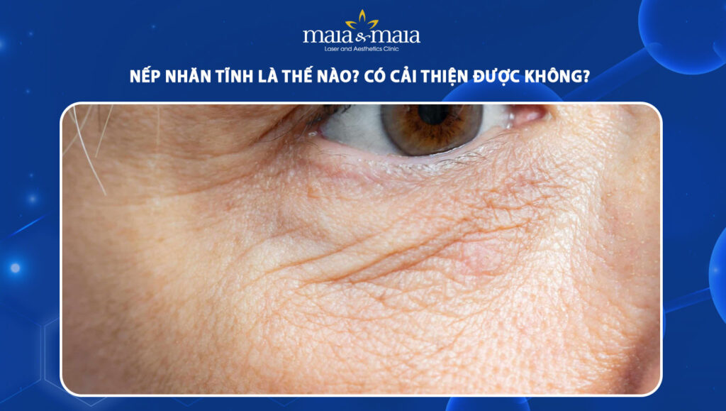 Nếp nhăn tĩnh là như thế nào? Có cải thiện được không? 1 nếp nhăn tĩnh