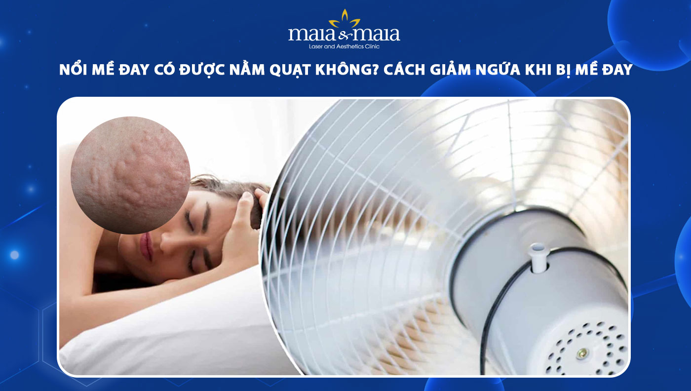 nổi mề đay có được nằm quạt không