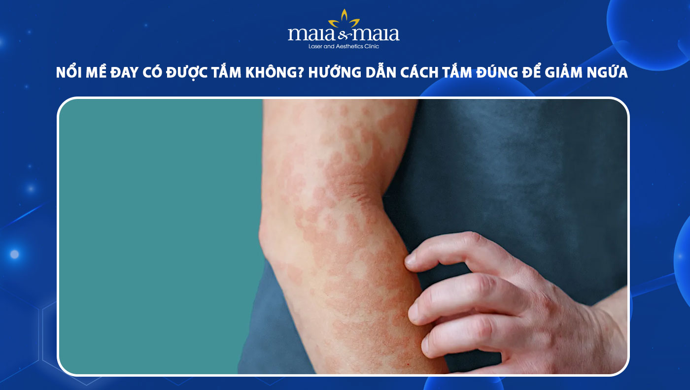 nổi mề đay có được tắm không