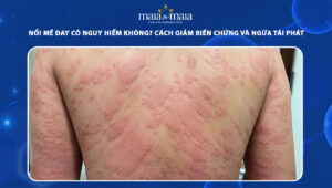 nổi mề đay có nguy hiểm không