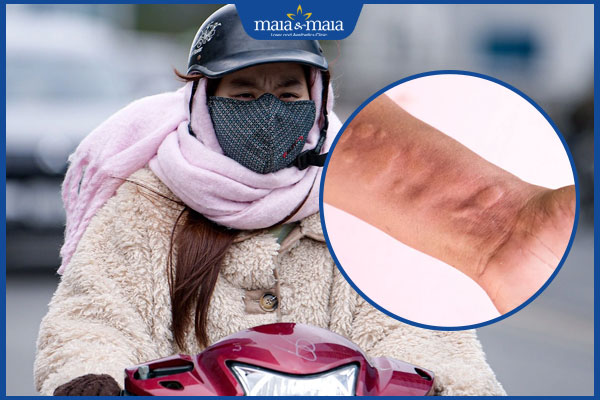 nổi mề đay do gió lạnh