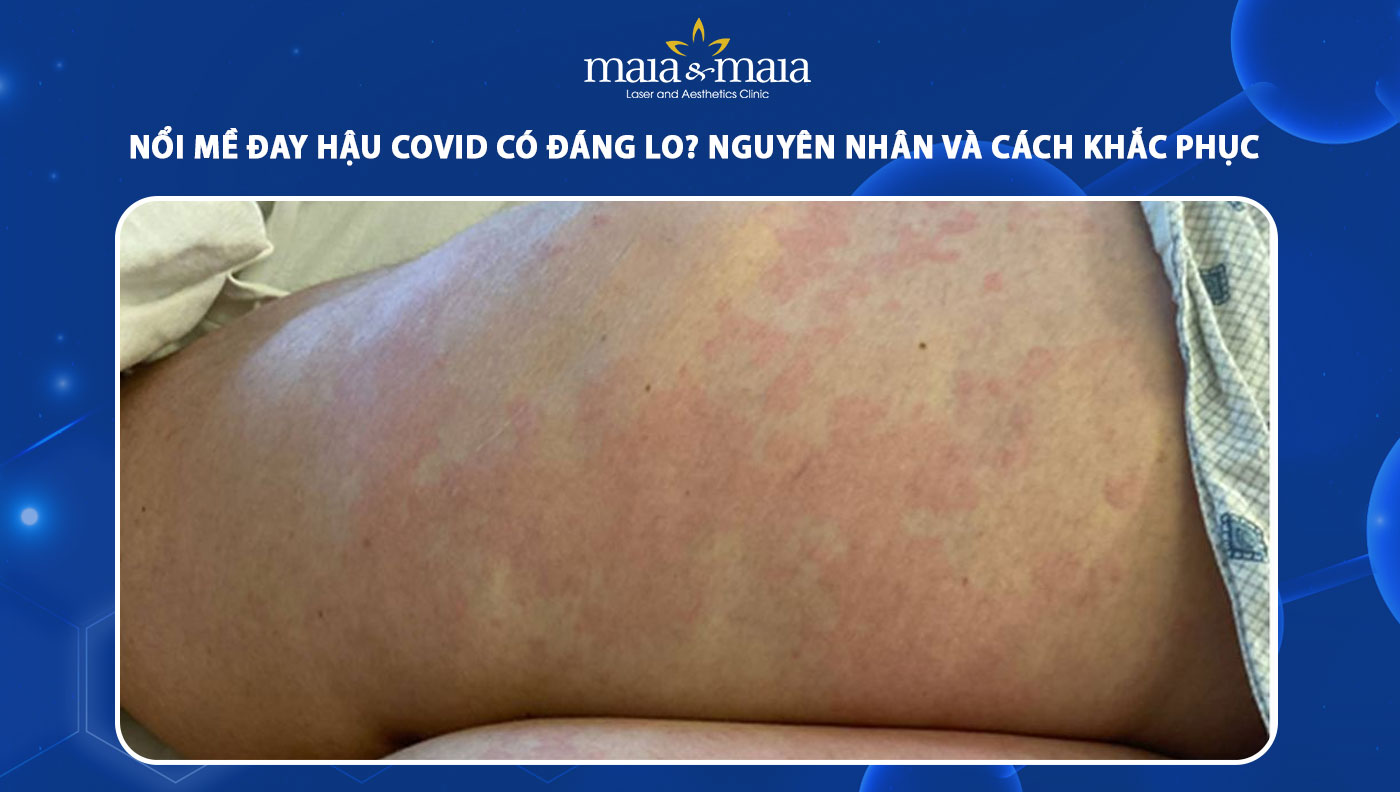 nổi mề đay hậu covid