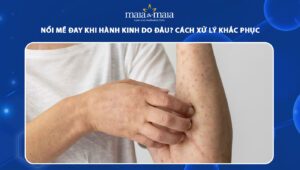 nổi mề đay khi hành kinh