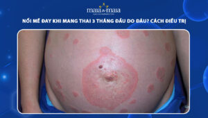 nổi mề đay khi mang thai 3 tháng đầu