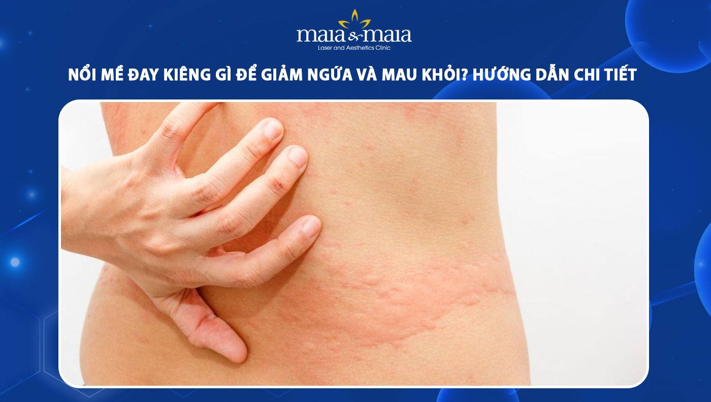 nổi mề đay kiêng gì