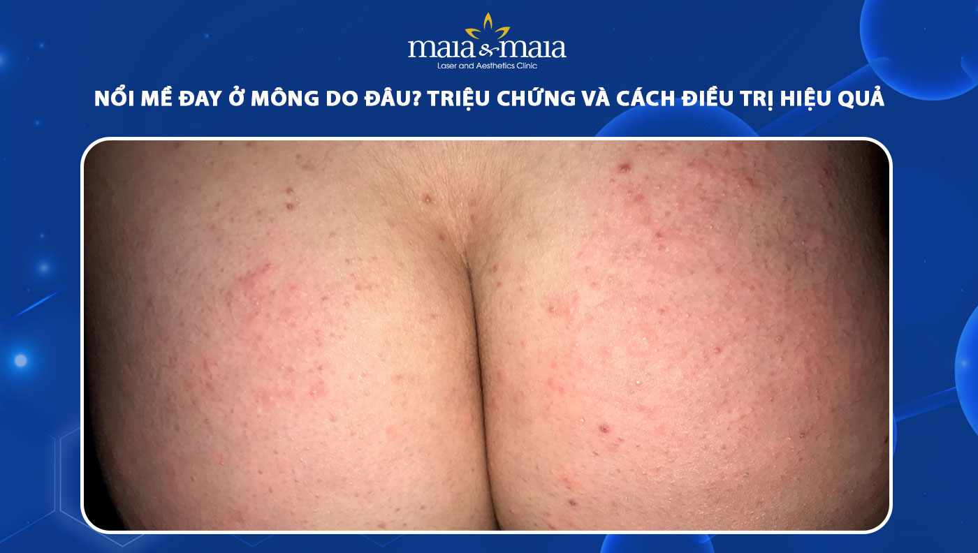 nổi mề đay ở mông